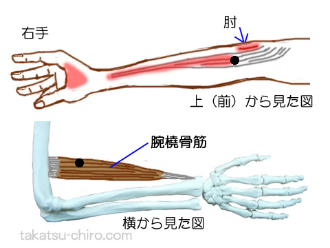 腕橈骨筋トリガーポイントの関連痛領域