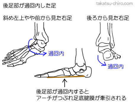 足の過度の回内から足裏の痛み足底腱膜炎