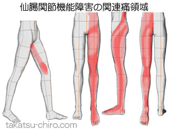 仙腸関節機能障害からの足の痛みの領域