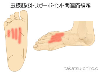 虫様筋（足）の足の痛みの領域