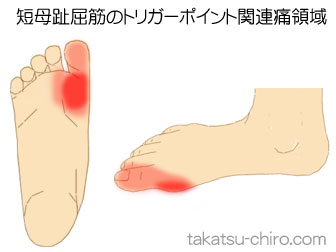 短母趾屈筋の足の痛みの領域