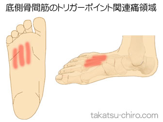 底側骨間筋の足の痛みの領域