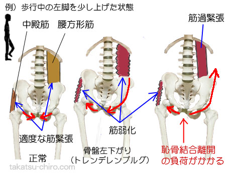 歩行時、中殿筋の弱化と腰方形筋の過緊張が原因で恥骨結合離開の恥骨痛