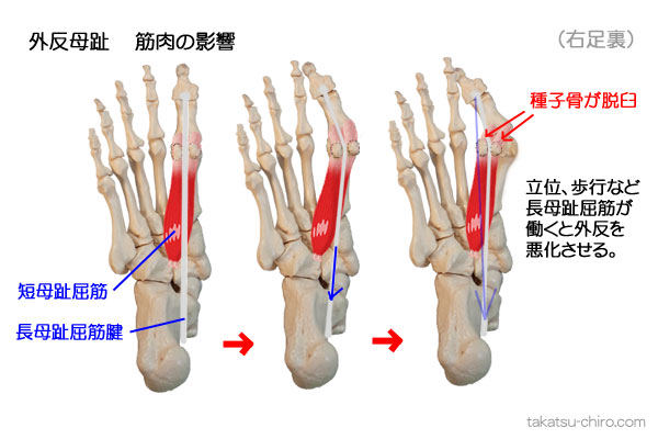 足の筋肉の外反母趾への影響