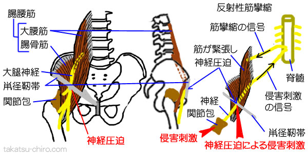 股関節関節包の侵害刺激による筋緊張から大腿神経圧迫による鼡径部の痛み