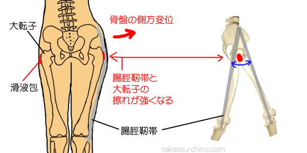 骨盤の側方変位よる骨盤側方の痛み