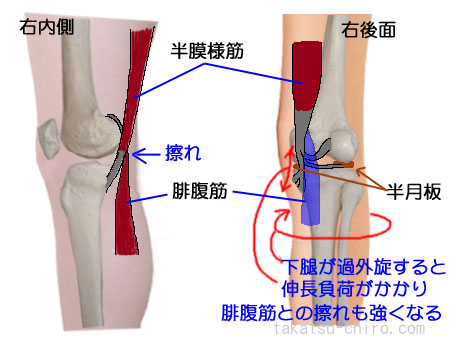 膝下内側やや後面の痛み半膜様筋