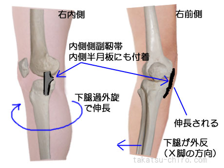 膝内側の痛み内側側副靭帯