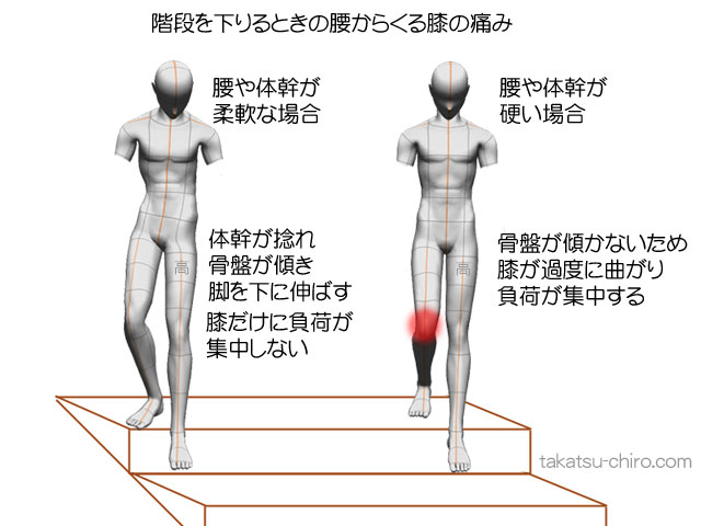 階段を下りるときの腰からくる膝の痛み