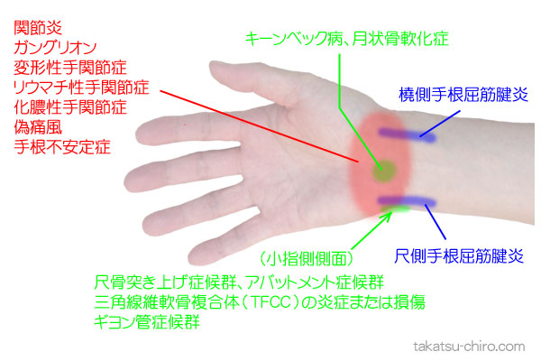 手首の掌側の痛み、手首の小指側の痛み