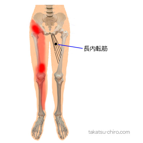 長内転筋のトリガーポイント関連痛領域
