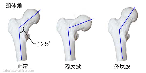股関節の正常な頸体角、内反股、外反股