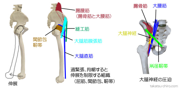 過緊張、拘縮すると股関節を伸展制限する筋、関節包、靭帯、大腿神経の圧迫