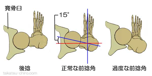 股関節の正常な前捻角、後捻、過度な前捻角