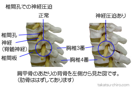 椎間孔で脊髄神経が圧迫されている図説