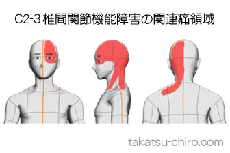 頸椎の椎間関節機能障害からの顔の痛みの領域