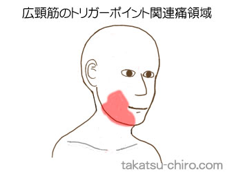 広頸筋の顔の痛みの領域