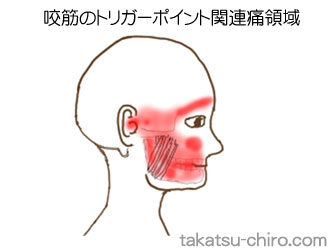咬筋の顔の痛みの領域