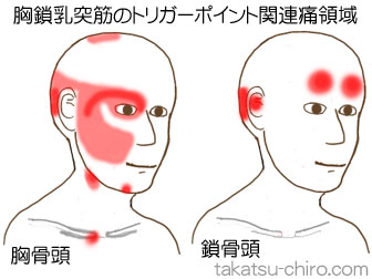 胸鎖乳突筋の顔の痛みの領域