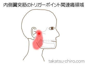 内側翼突筋の顔の痛みの領域