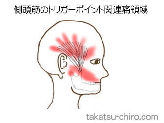 側頭筋の顔の痛みの領域