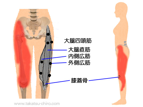 大腿四頭筋トリガーポイントの関連痛領域