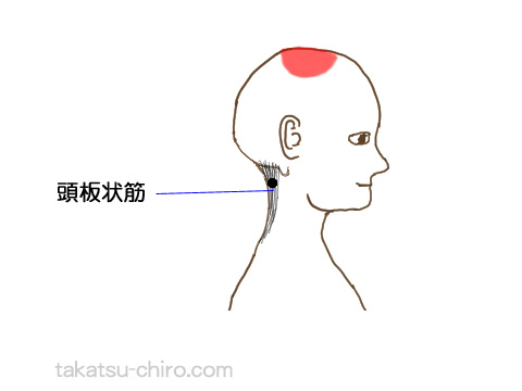 頭板状筋トリガーポイントの関連痛領域