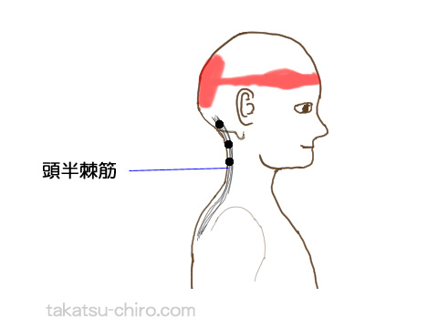 頭半棘筋トリガーポイントの関連痛領域
