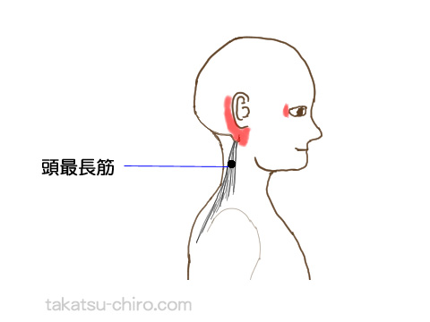 頭最長筋トリガーポイントの関連痛領域