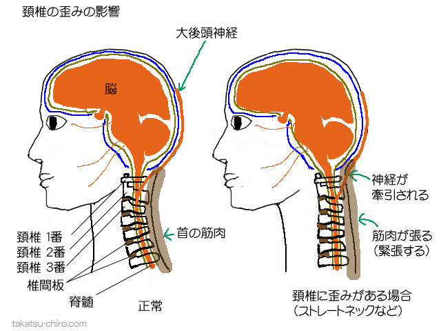 図・首の歪み・大後頭神経・筋緊張